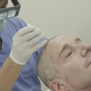 microinjerto-de-cabello-tecnica-fue