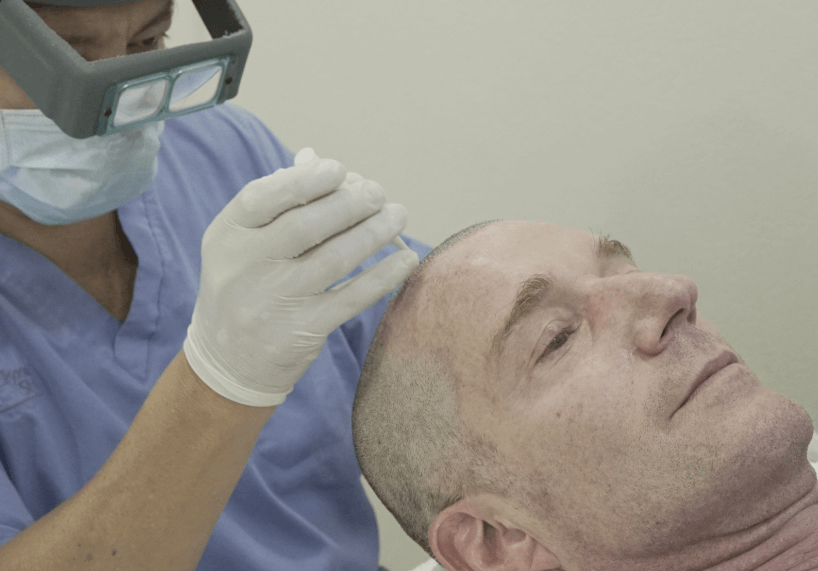 10 razones para hacerte un implante de cabello