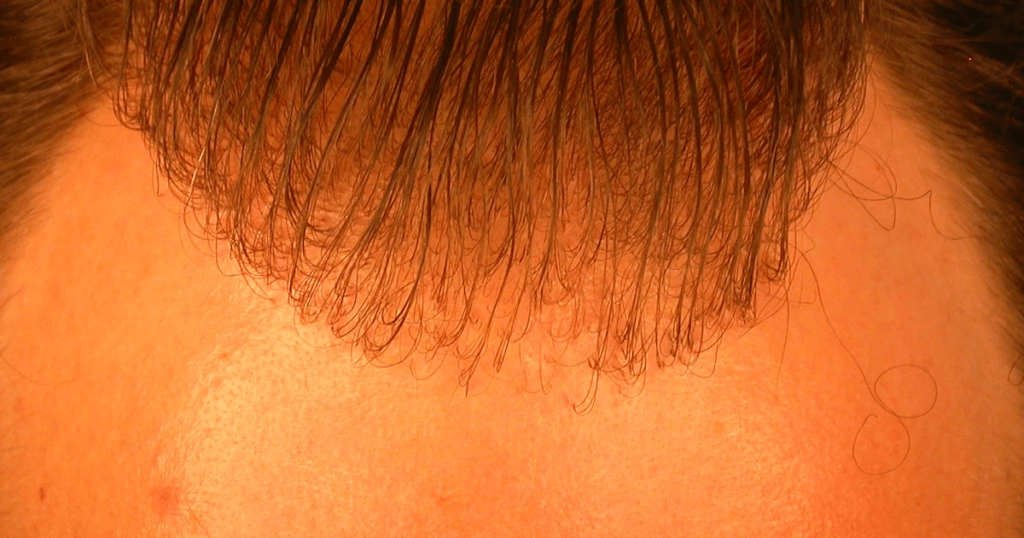 Cómo distinguir un mal implante de cabello