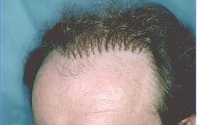 transplante-mal-realizado-con-aparencia-de-cabello-de-muneca