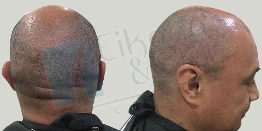 Testimonio: microinjerto de cabello a nuestro paciente número 7,000