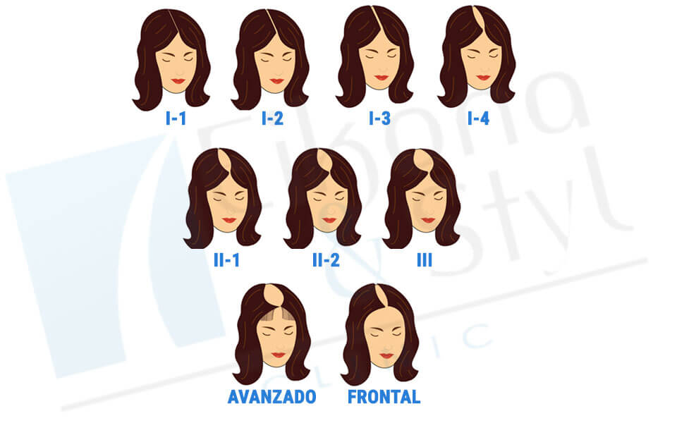 Conoce qué tan grave es tu calvicie – Mujeres