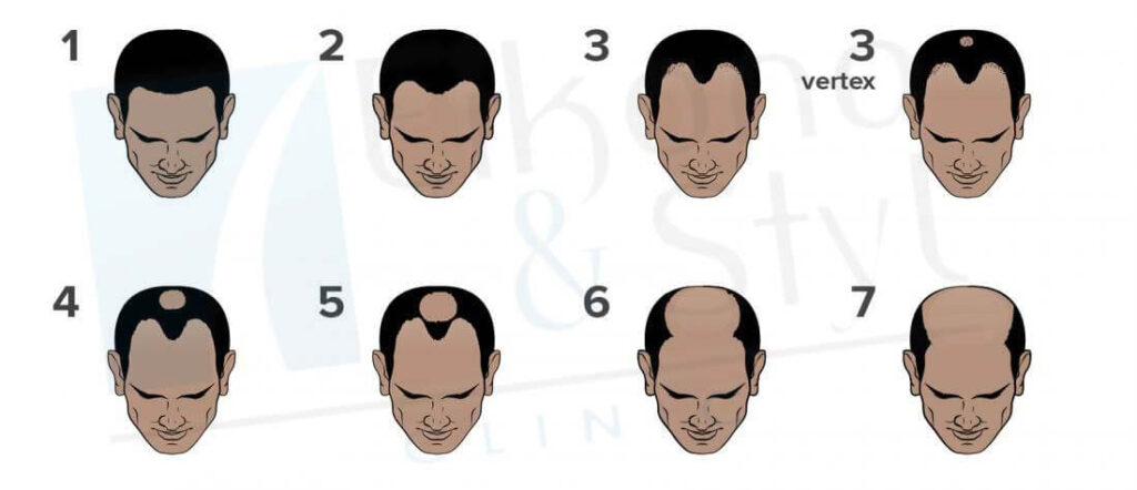 Conoce qué tan grave es tu calvicie – Hombres