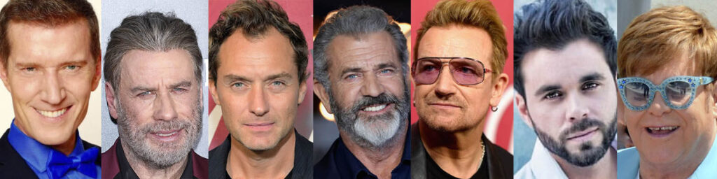 7 famosos con implante de cabello