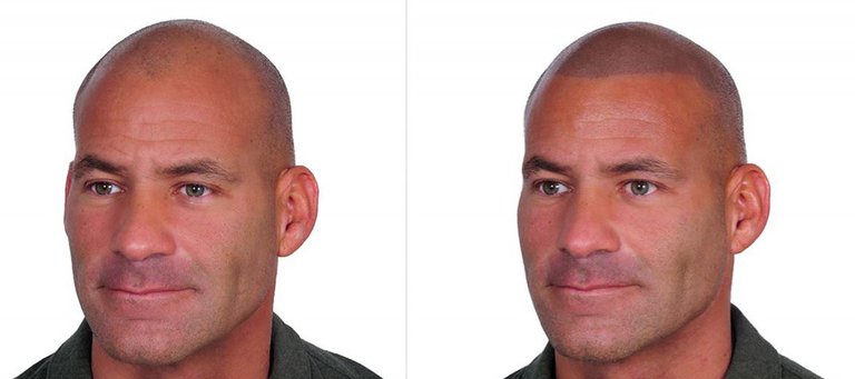 Desventajas de la micropigmentación capilar