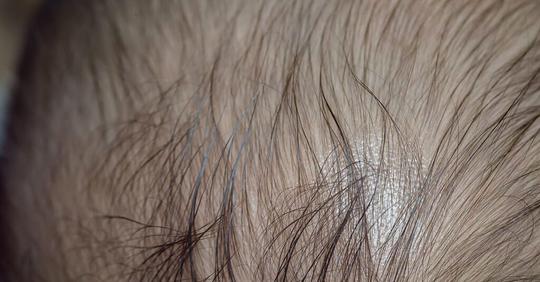 Sobre la calvicie infantil