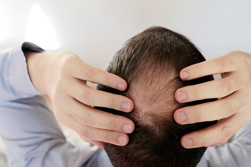 ¿El pelo injertado se caerá?