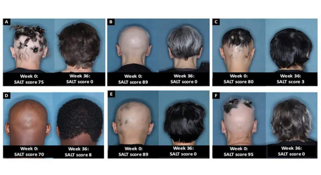 Baricitinib, el nuevo medicamento contra la calvicie